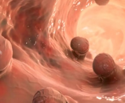 Khi nào cần đi khám bác sĩ để kiểm tra polyp đại tràng?